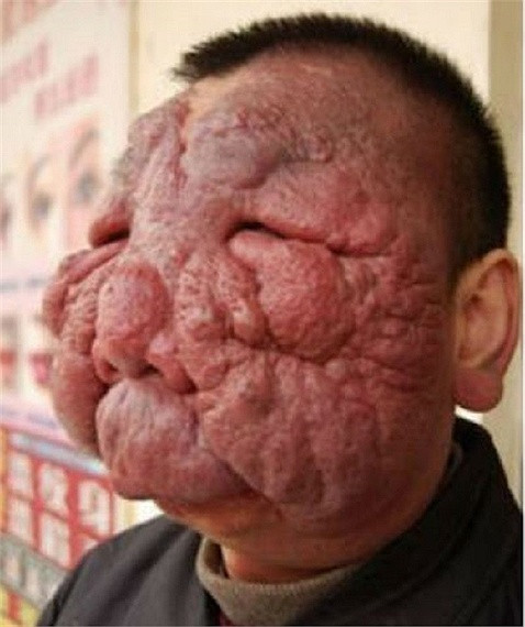 Anh Wu Qiang – 33 tuổi, người Trung Quốc đã sống chung với các khối u trên mặt trong nhiều năm qua. Kích thước của chúng phát triển ngày một khổng lồ và che đi toàn bộ khuôn mặt khiến anh không thể nhìn và rất khó thở