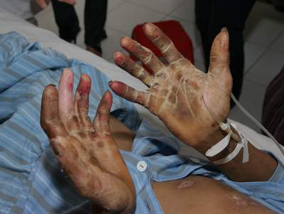 Biểu hiện trên da của người bệnh nhiễm liên cầu lợn