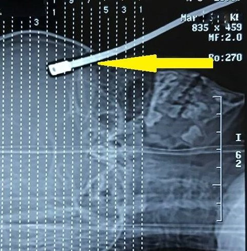 Cứu sống ngoạn mục bé trai bị thanh sắt đâm xuyên não ảnh 1