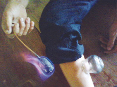 Đồ dùng giác hơi. Ảnh:Trần Nguyễn Anh. Đồ dùng giác hơi. Ảnh:Trần Nguyễn Anh