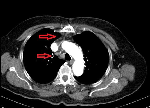 Phim chụp khối u kỳ quái khổng lồ chứa đầy xơ mỡ, lông, tóc của ngườ phụ nữ Phú Thọ. Ảnh: BS cung cấp Phim chụp khối u kỳ quái khổng lồ chứa đầy xơ mỡ, lông, tóc của ngườ phụ nữ Phú Thọ. Ảnh: BS cung cấp