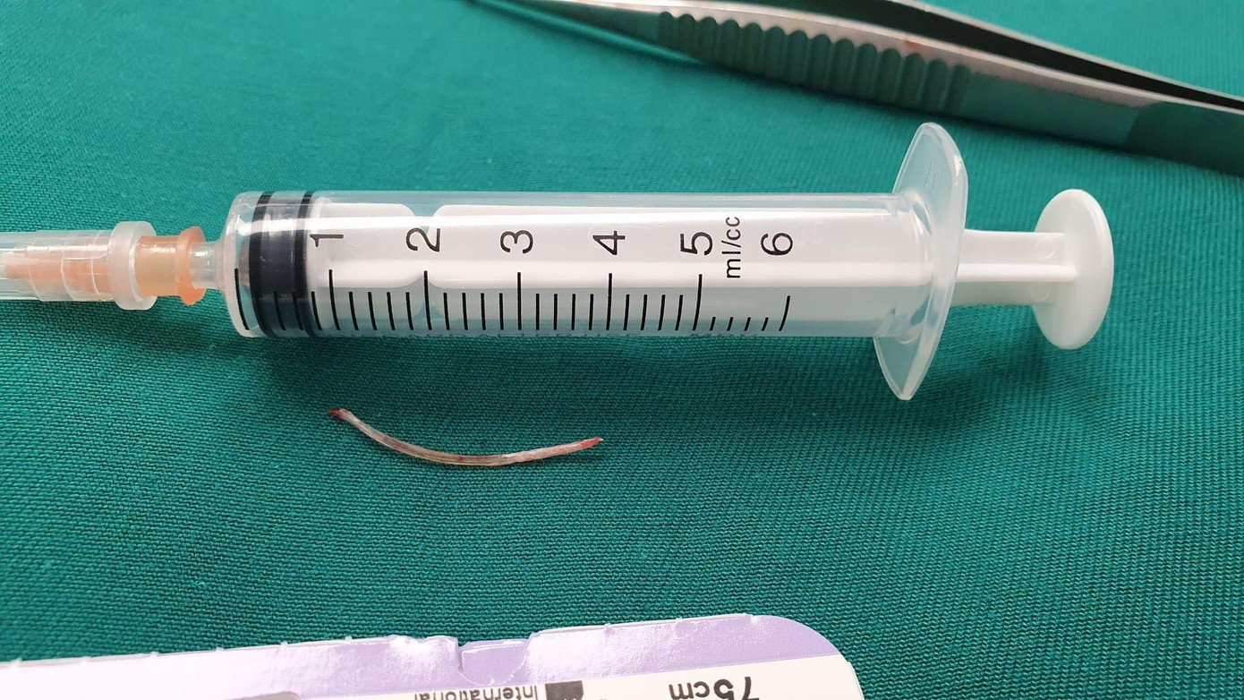 Dị vật xương cá dài khoảng 3cm sau khi được lấy ra khỏi cổ bé trai. Ảnh: BS cung cấp