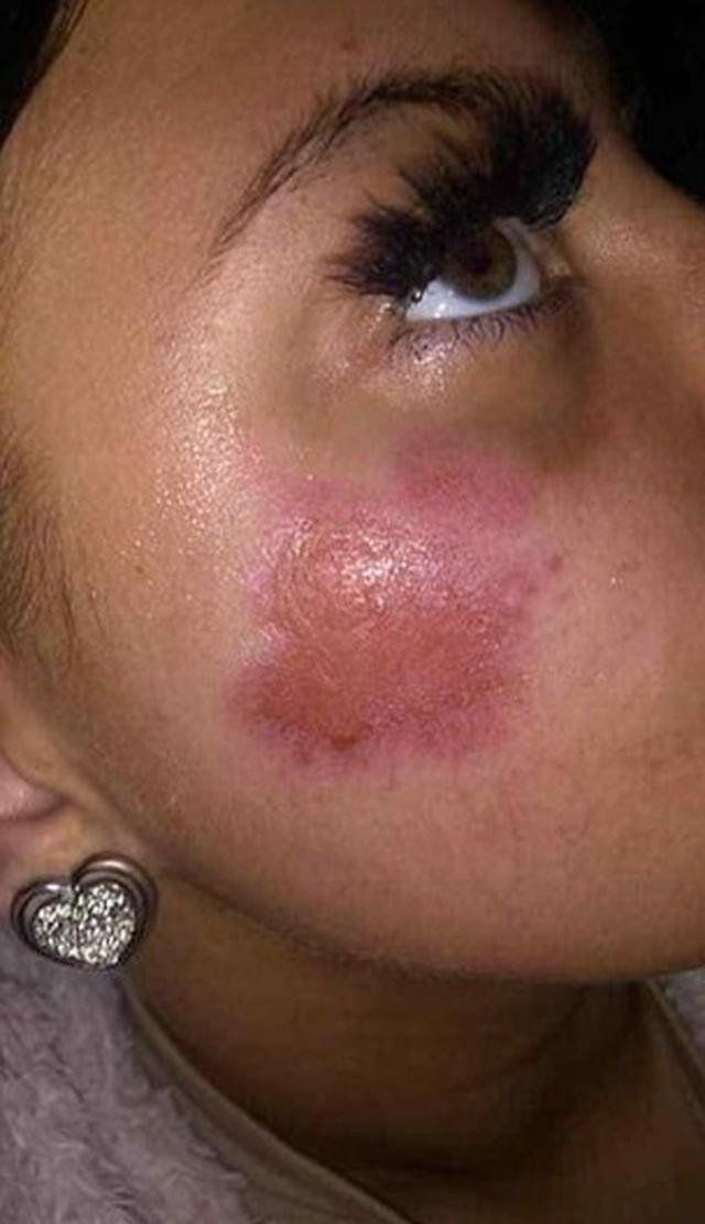 Vết bỏng trên mặt Amie Hall sau vụ nổ.