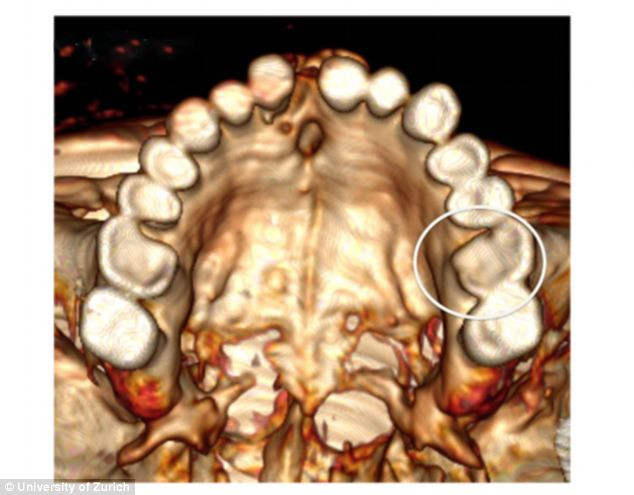 Chiếc răng bị sâu của người băng Otzi