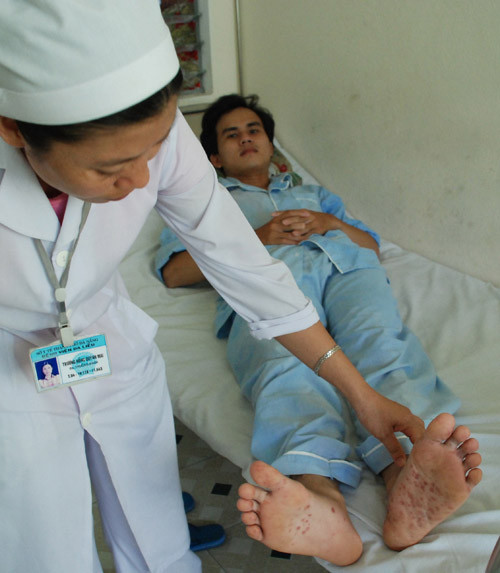 Anh N.H.Đ. (ngụ Đà Nẵng) đang chờ kết quả xét nghiệm từ Viện Pasteur Nha Trang sau khi được Bệnh viện Da liễu Đà Nẵng chẩn đoán bị tay chân miệng. Ảnh: Hữu Khá