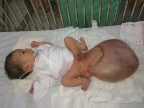 PGS Bích cũng vừa phẫu thuật cắt bỏ khối u quái cho bé B.V sinh ngày 5-12-2012