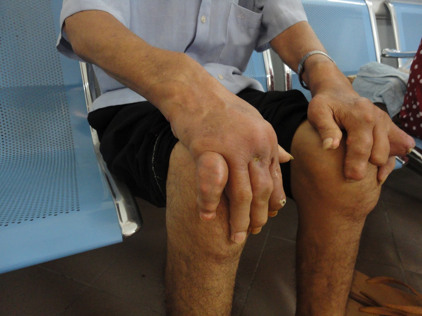 Theo từng giai đoạn tiến triển của bệnh, triệu chứng và tổn thương khớp sẽ ngày càng nghiêm trọng hơn. Điều trị tốt nhất vẫn là khi phát hiện bệnh gout ở giai đoạn sớm.