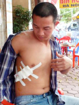 chủ quán bia với vết thương trên người