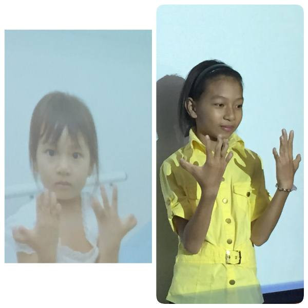 8 bệnh nhân dị tật bàn tay bẩm sinh sẽ được phẫu thuật miễn phí ảnh 1