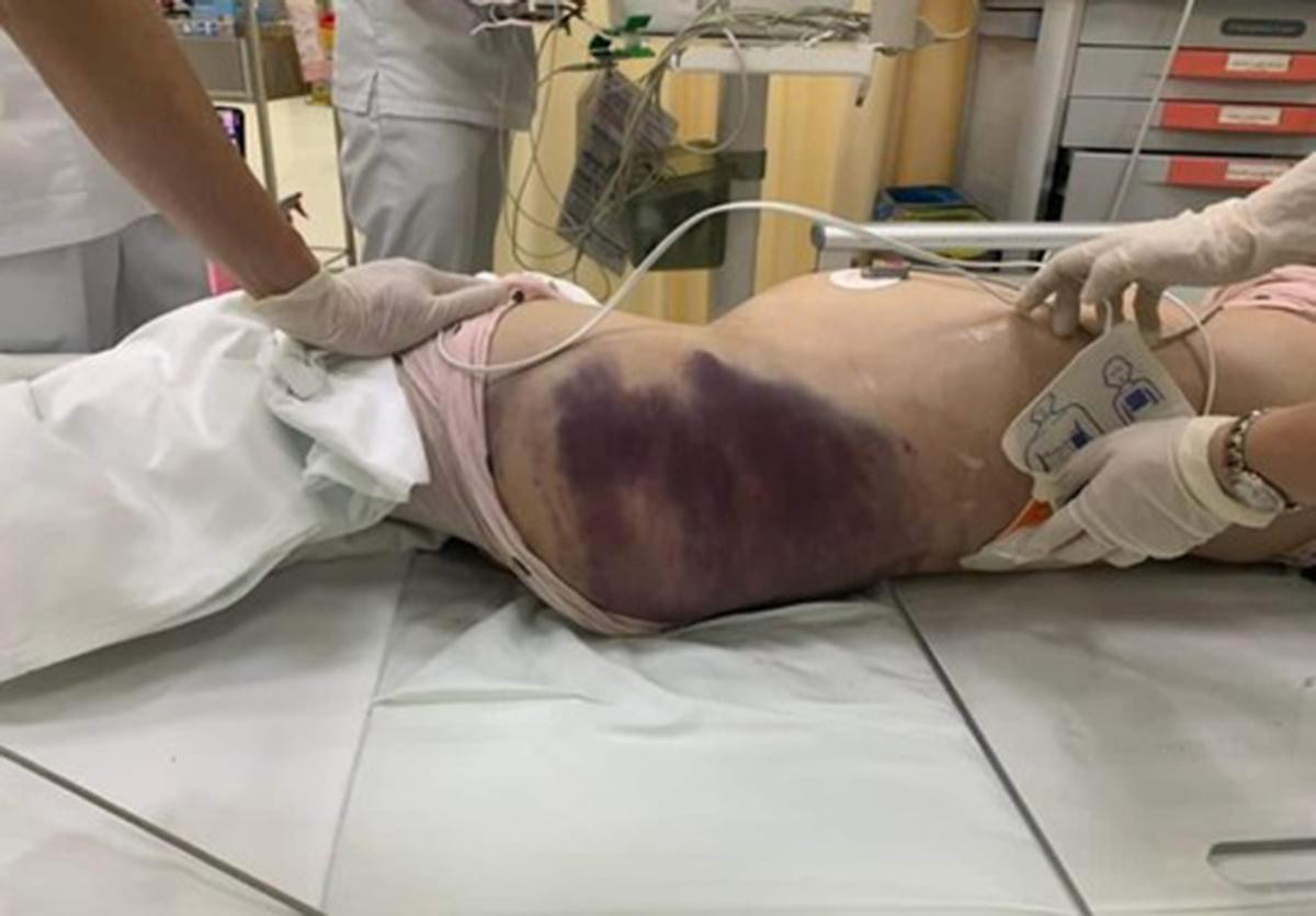 Cơ thể bé V.A có nhiều vết bầm tím.