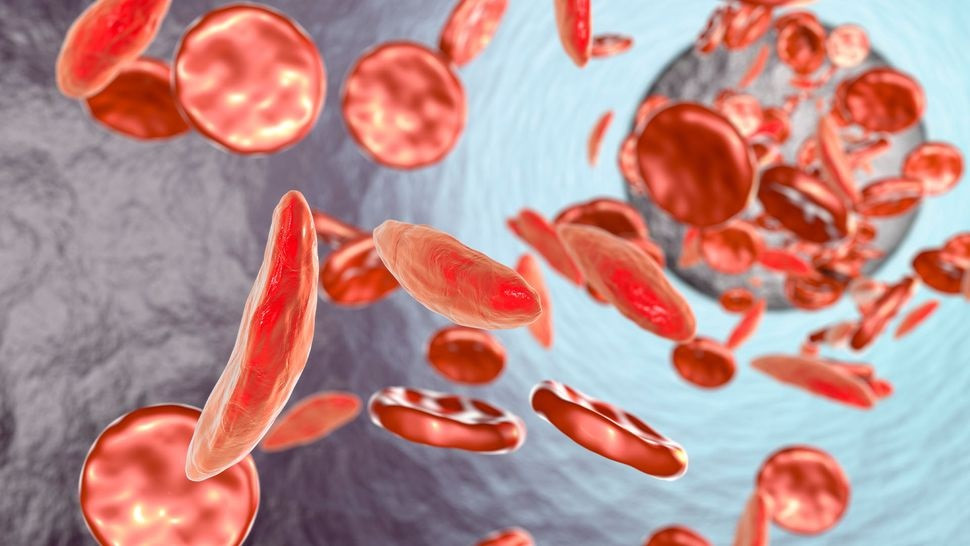 Ở những bệnh nhân mắc bệnh hồng cầu hình lưỡi liềm, một số tế bào hồng cầu của họ có hình lưỡi liềm và không thể vận chuyển oxy đi khắp cơ thể một cách hiệu quả. (Ảnh: KATERYNA KON/THƯ VIỆN ẢNH KHOA HỌC qua Getty Images)