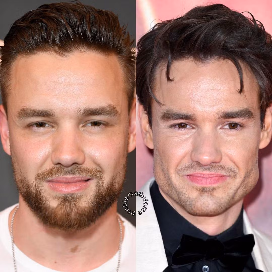 Liam Payne là trường hợp phẫu thuật thẩm mỹ thất bại tiêu biểu. Cựu thành viên nhóm One Direction bỗng già đi chục tuổi sau khi loại bỏ hai bên mỡ má.