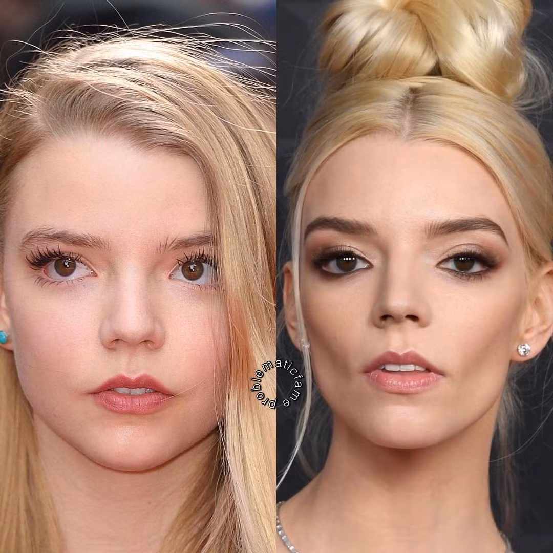 Anya-Taylor Joy thay đổi từ một cô bé đầy ngây thơ trở nên trưởng thành hơn sau khi thực hiện thu gọn gò má.