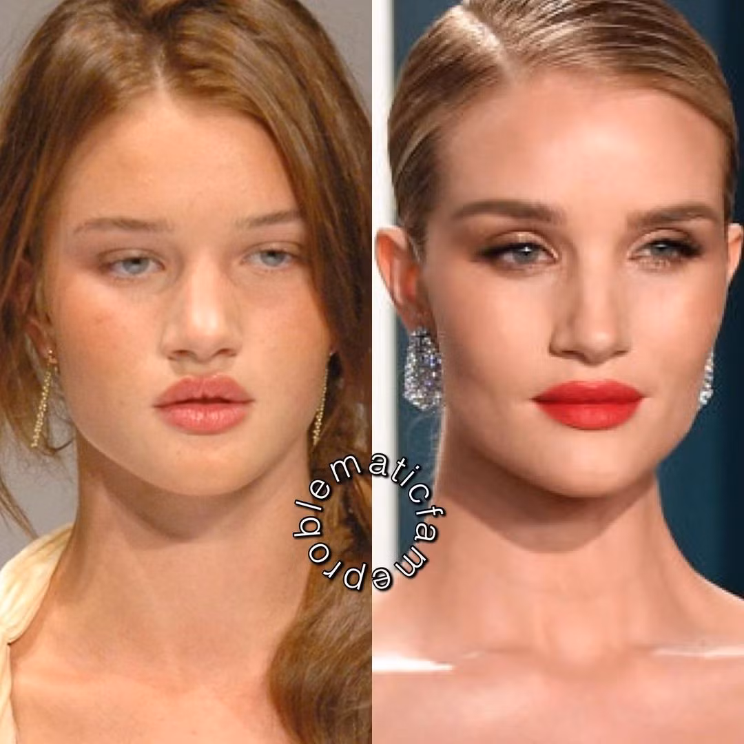 Rosie Huntington-Whiteley thu hút hơn với phần cằm nhỏ gọn sau phẫu thuật.