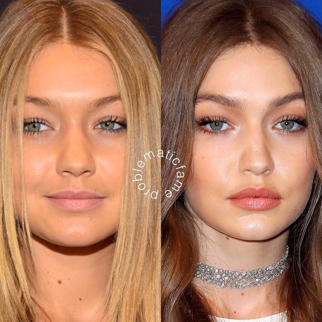 Gigi Hadid được "soi ra" đã thay đổi khá nhiều thứ trên gương mặt, bao gồm cả phần cằm.
