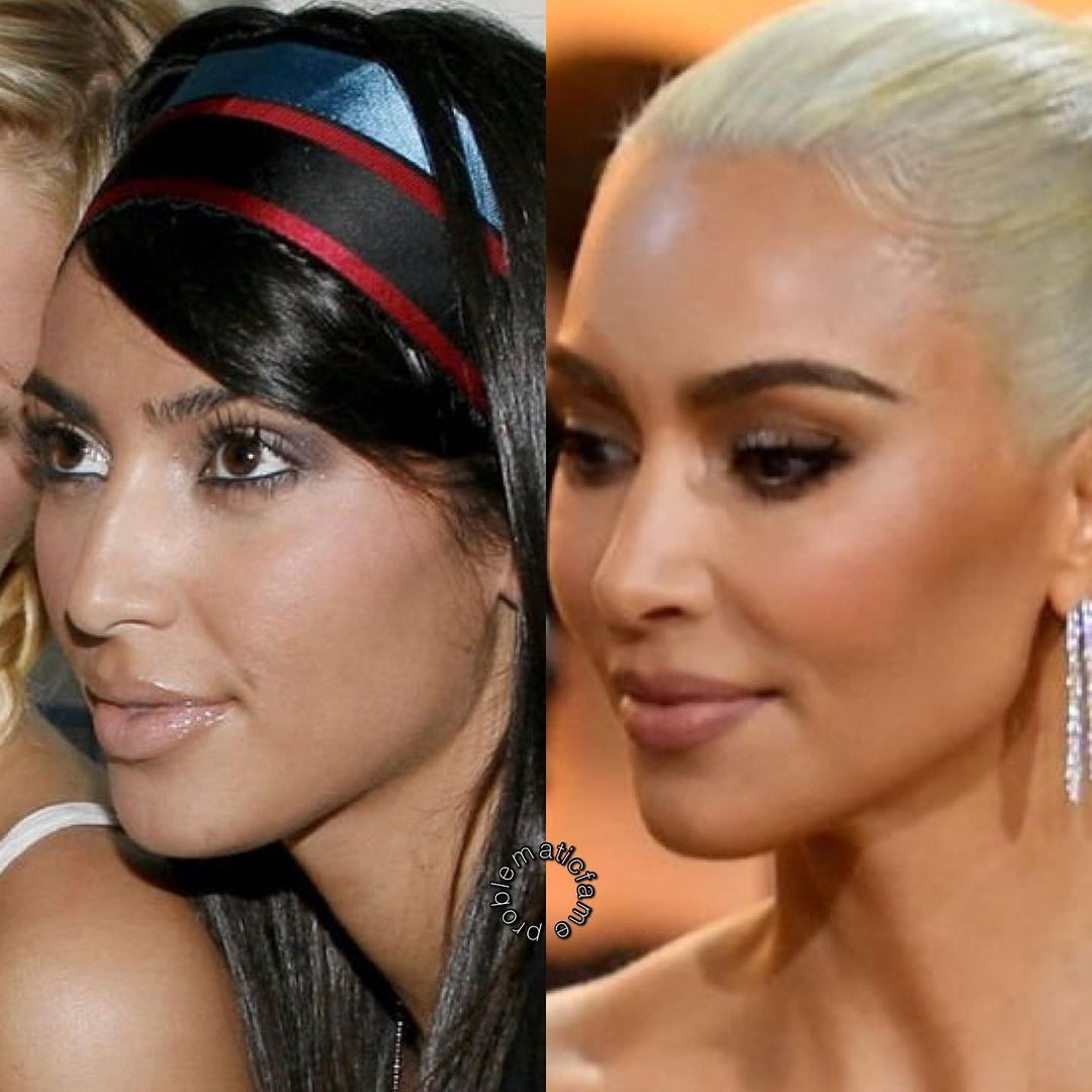 Một người đam mê dao kéo như Kim Kardashian khó mà không thực hiện phẫu thuật thu gọn gò má. Một người đam mê dao kéo như Kim Kardashian khó mà không thực hiện phẫu thuật thu gọn gò má.