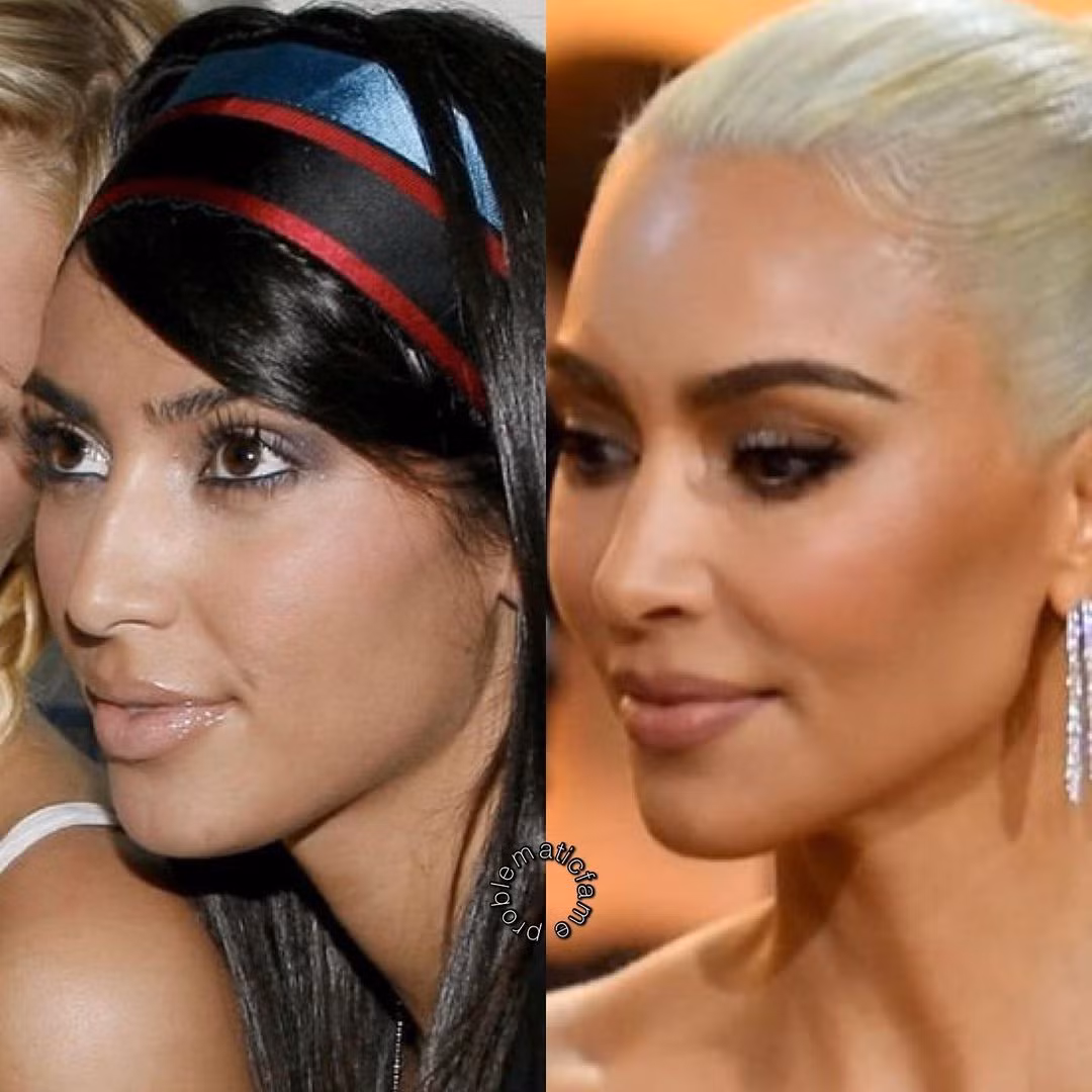 Một người đam mê dao kéo như Kim Kardashian khó mà không thực hiện phẫu thuật thu gọn gò má.