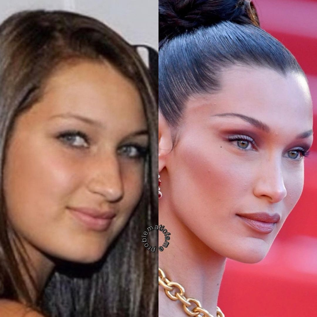 Bella Hadid có một cú lội ngược dòng nhan sắc ngoạn mục nhờ thủ thuật lấy mỡ má. Bella Hadid có một cú lội ngược dòng nhan sắc ngoạn mục nhờ thủ thuật lấy mỡ má.