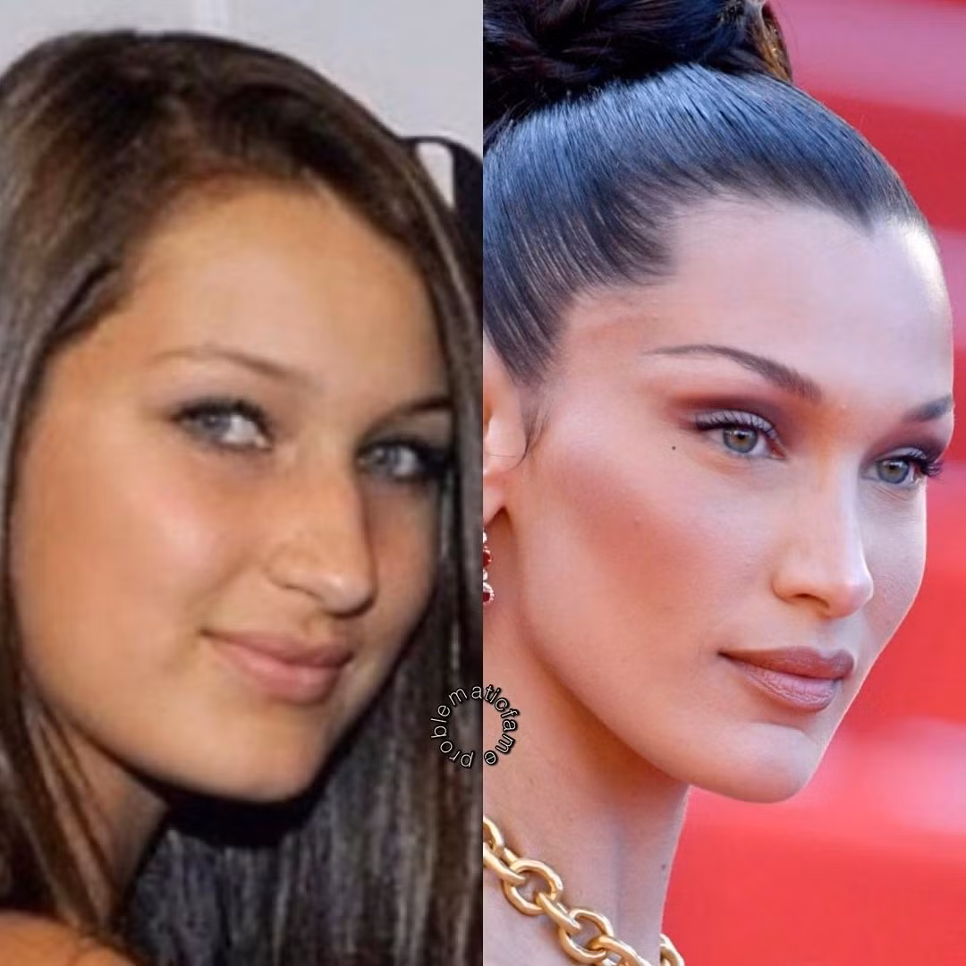 Bella Hadid có một cú lội ngược dòng nhan sắc ngoạn mục nhờ thủ thuật lấy mỡ má.