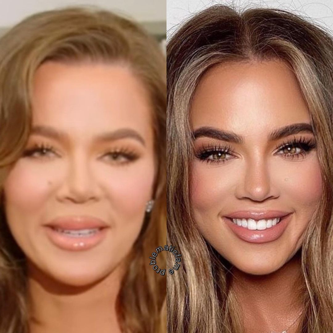 Khloe Kardashian trẻ ra cả chục tuổi sau khi thu gọn gò má. Khloe Kardashian trẻ ra cả chục tuổi sau khi thu gọn gò má.