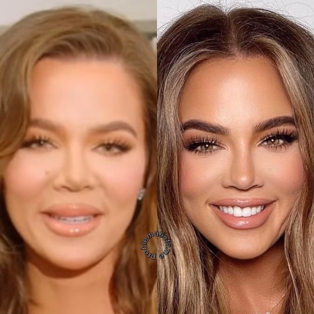 Khloe Kardashian trẻ ra cả chục tuổi sau khi thu gọn gò má.