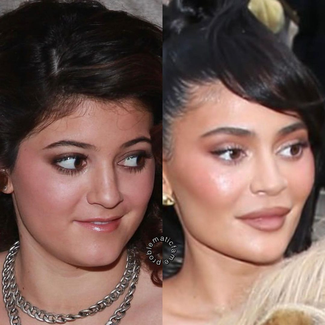 Kylie Jenner không thoát khỏi mắt cú vọ của dân mạng. Khán giả cho rằng cô đã làm nhiều thủ thuật thẩm mỹ, bao gồm cả lấy mỡ gò má. Kylie Jenner không thoát khỏi mắt cú vọ của dân mạng. Khán giả cho rằng cô đã làm nhiều thủ thuật thẩm mỹ, bao gồm cả lấy mỡ gò má.