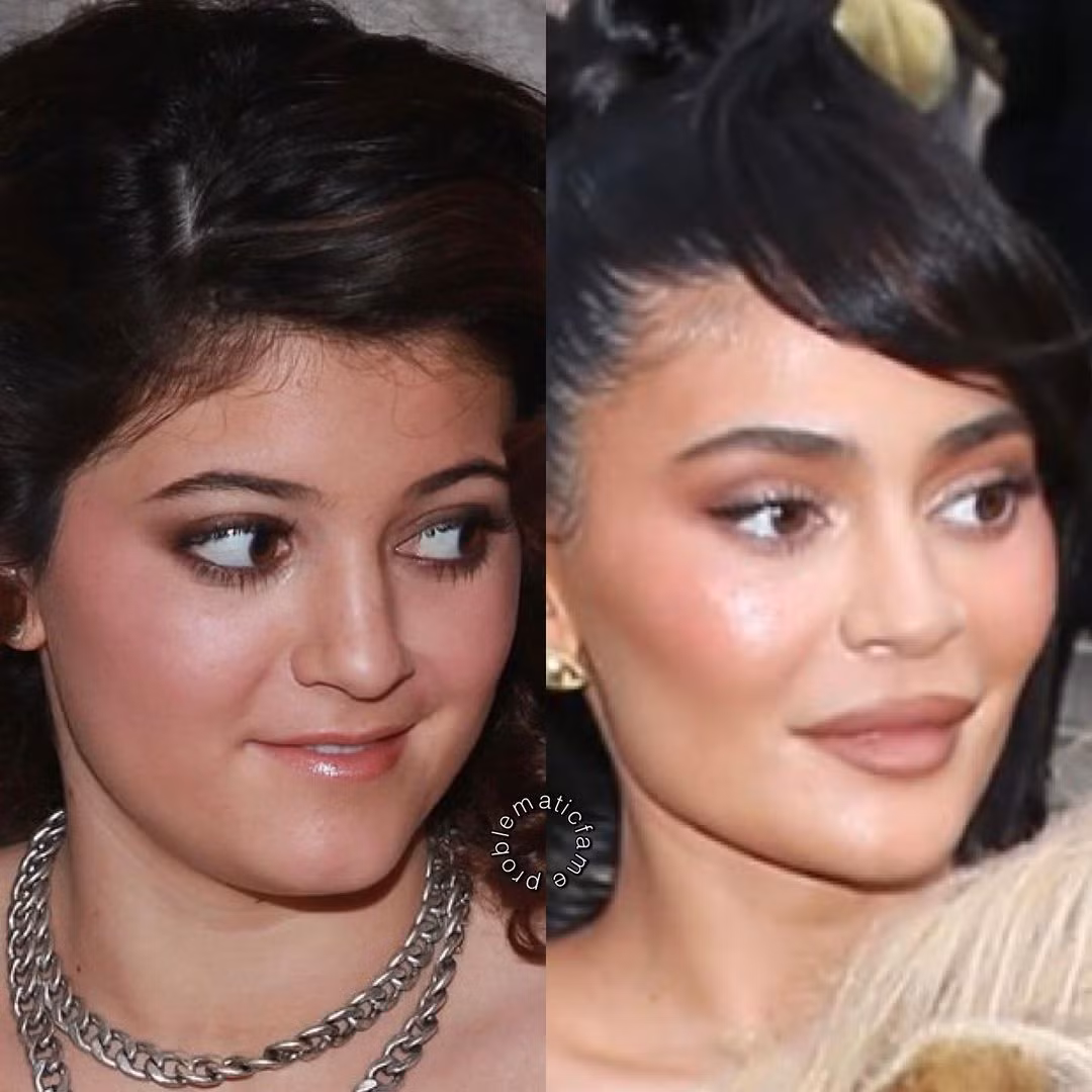 Kylie Jenner không thoát khỏi mắt cú vọ của dân mạng. Khán giả cho rằng cô đã làm nhiều thủ thuật thẩm mỹ, bao gồm cả lấy mỡ gò má.