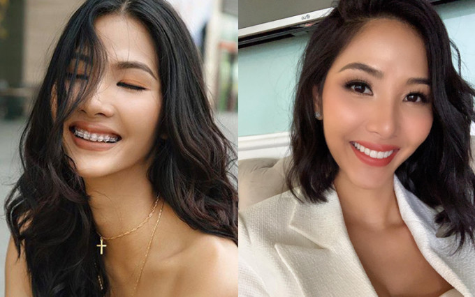 Á hậu Hoàng Thùy cũng sử dụng phương pháp niềng răng. Á hậu Hoàng Thùy cũng sử dụng phương pháp niềng răng.