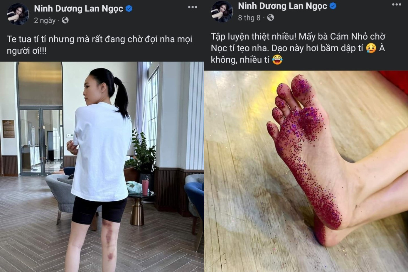 Ninh Dương Lan Ngọc chia sẻ hình ảnh đôi chân bị bầm tím do tập luyện.