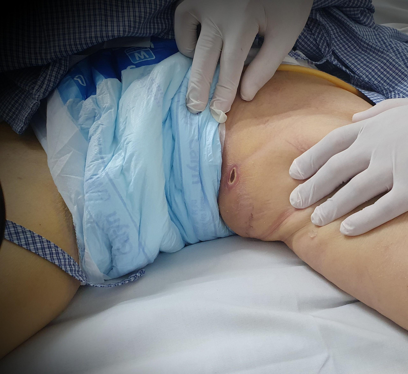 Vết loét điển hình trên vùng bẹn của bệnh nhân sốt mò - một dấu hiệu để phân biệt sốt mò và các bệnh truyền nhiễm khác. Ảnh: Bệnh viện cung cấp Vết loét điển hình trên vùng bẹn của bệnh nhân sốt mò - một dấu hiệu để phân biệt sốt mò và các bệnh truyền nhiễm khác. Ảnh: Bệnh viện cung cấp