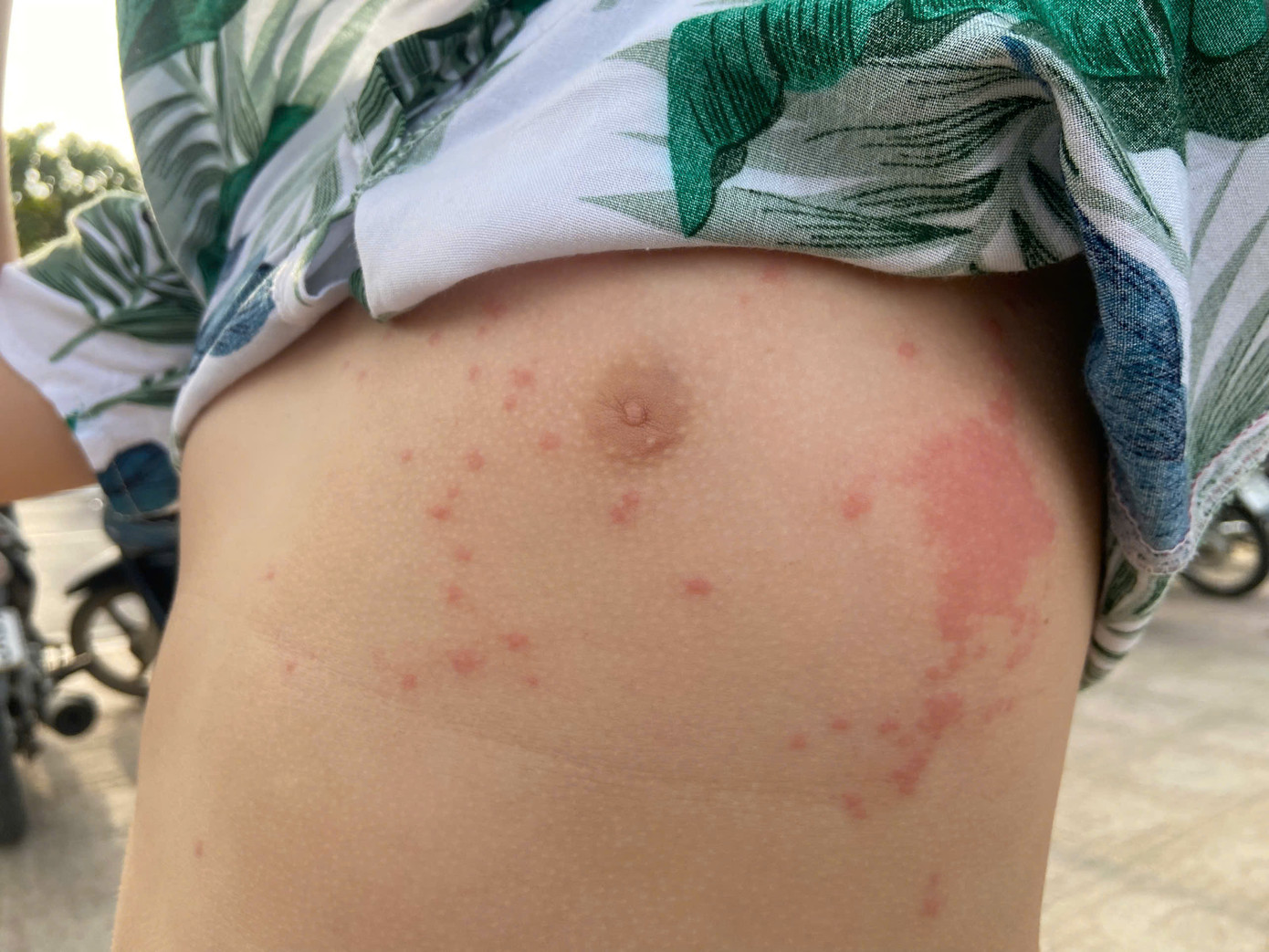 Bé Nhật Minh (Con chị Lài) bị sứa lửa "tấn công khi tắm biển Hòn Chồng. Bé Nhật Minh (Con chị Lài) bị sứa lửa "tấn công khi tắm biển Hòn Chồng.