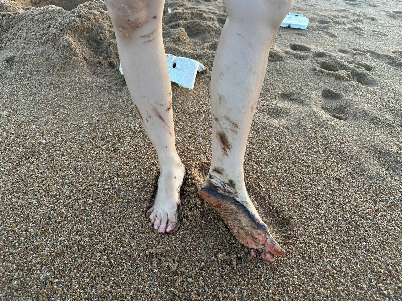 Dầu dính vào người đi tắm biển.