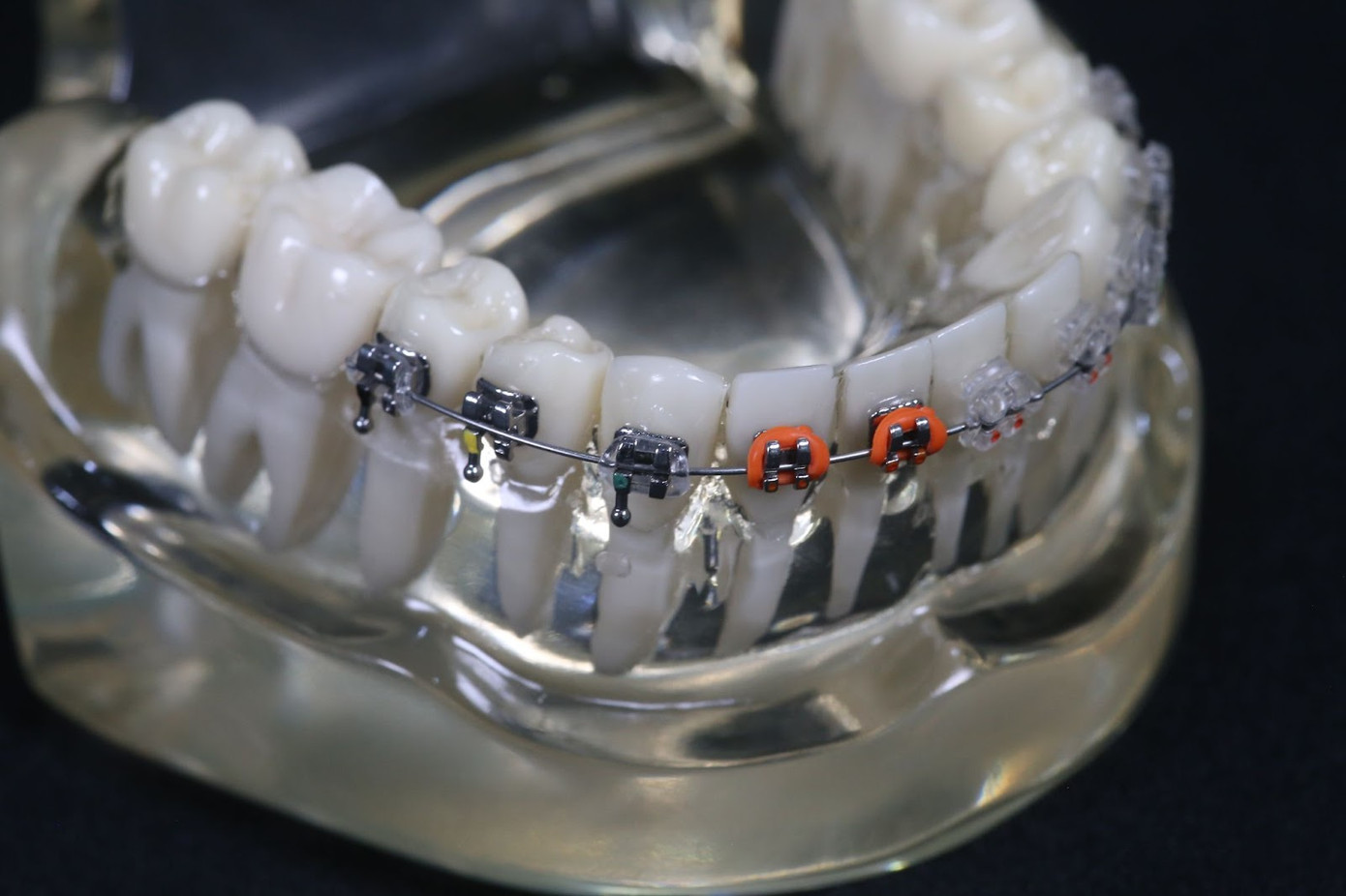 Giá niềng răng phụ thuộc nhiều vào loại niềng và người bệnh chọn