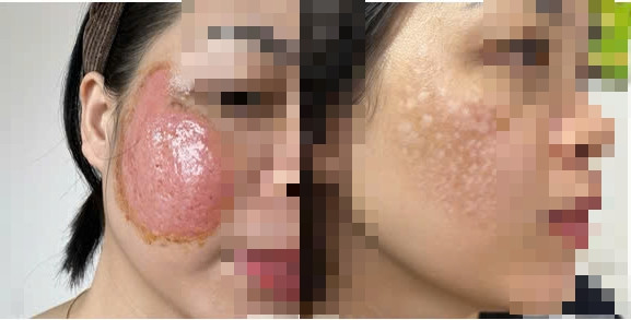 Khách hàng bị tổn thương vùng da nghiêm trọng sau khi trị nám sai cách tại một spa. (Ảnh internet)