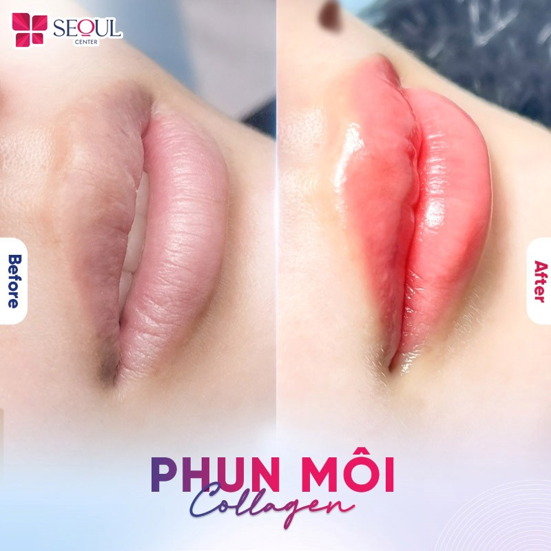 Phun môi Collagen là công nghệ phun môi kết hợp sử dụng tinh chất Collagen và mực hữu cơ để môi căng mướt sau khi thực hiện Phun môi Collagen là công nghệ phun môi kết hợp sử dụng tinh chất Collagen và mực hữu cơ để môi căng mướt sau khi thực hiện
