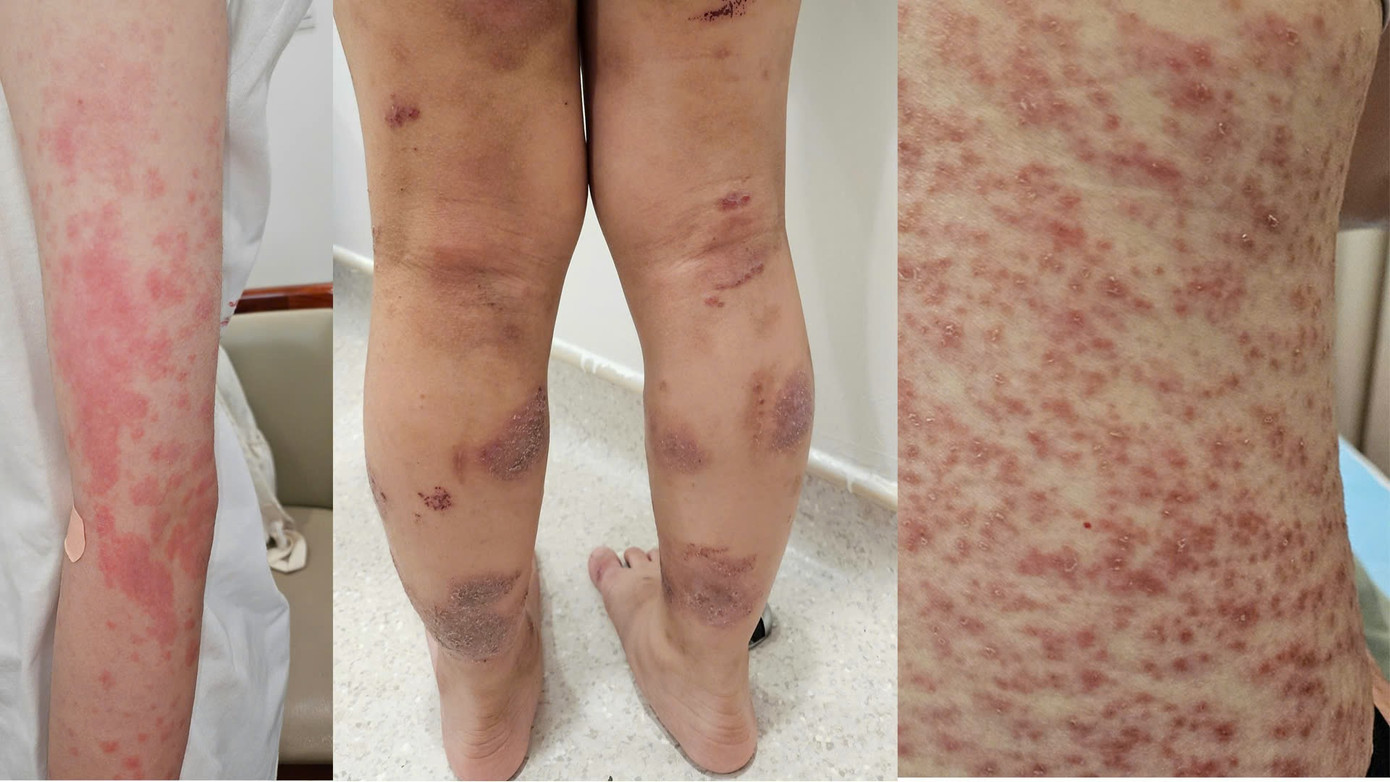 Trường hợp các bệnh liên quan đến dị ứng đến thăm khám tại Vinmec Trường hợp các bệnh liên quan đến dị ứng đến thăm khám tại Vinmec