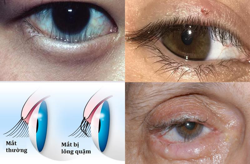 Quặm mi mắt - nguyên nhân gây viêm loét, thủng giác mạc Quặm mi mắt - nguyên nhân gây viêm loét, thủng giác mạc