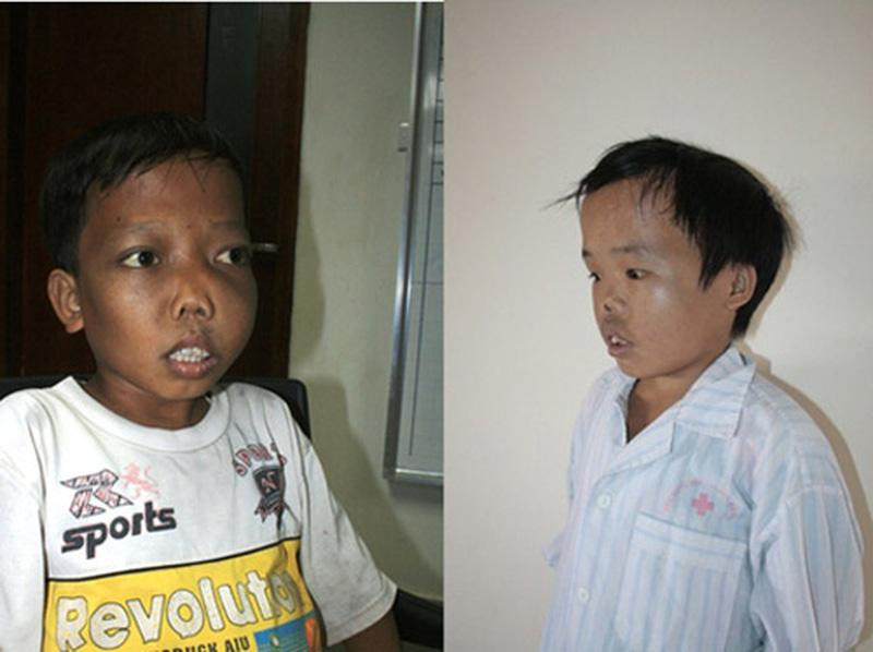 Trẻ mắc bệnh Thalassemia gây bất thường về hình dáng và nhiều biến chứng nguy hiểm. Ảnh minh họa. Nguồn Internet