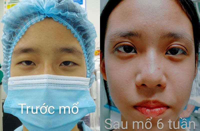 Bệnh nhân N tự tin sau khi được phẫu thuật quặm mi tại BVĐK MEDLATEC Bệnh nhân N tự tin sau khi được phẫu thuật quặm mi tại BVĐK MEDLATEC