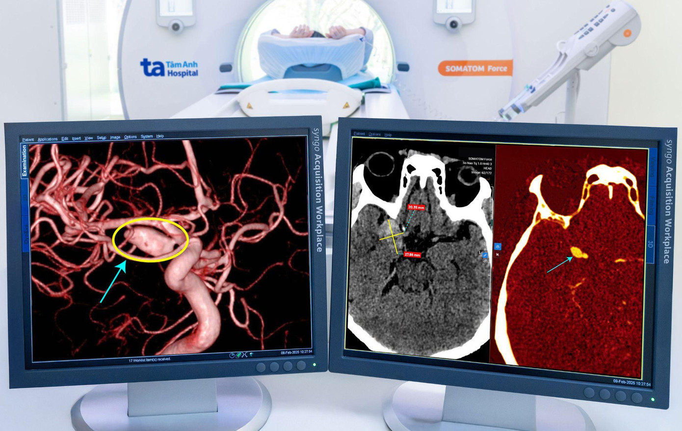 Hình ảnh vỡ túi phình mạch máu được phát hiện nhờ máy chụp CT hơn 100.000 lát cắt. Ảnh: BVĐK Tâm Anh.
