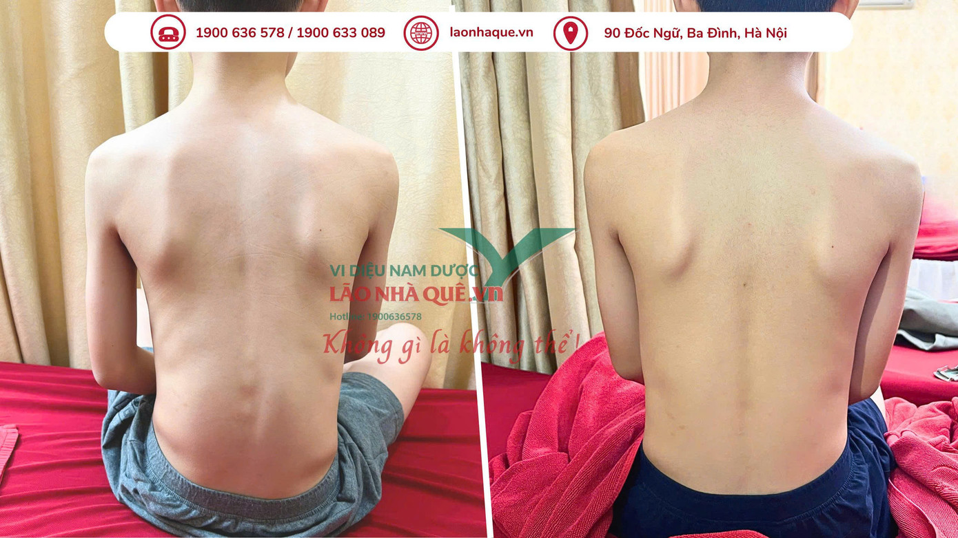 Hình ảnh bé trai 12 tuổi bị cong vẹo cột sống trước và sau trị liệu tại Phòng khám chuyên khoa YHCT Lão Nhà Quê – Vi diệu Nam Dược