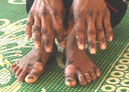 Biểu hiện dễ thấy nhất là ở ngoài da nhưng thực chất bệnh gây chảy máu tiêu hóa, suy gan... 