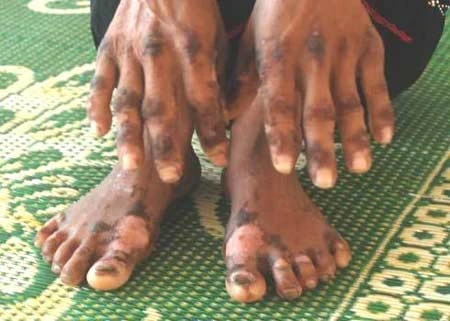 Biểu hiện dễ thấy nhất là ở ngoài da nhưng thực chất bệnh gây chảy máu tiêu hóa, suy gan... 