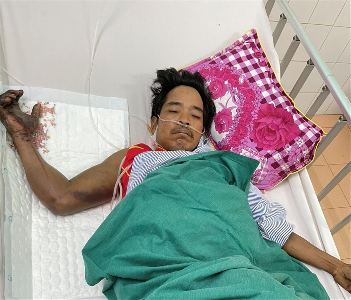 Một bệnh nhân bị rắn hổ mang chúa cắn phải nhập viện ở Gia Lai