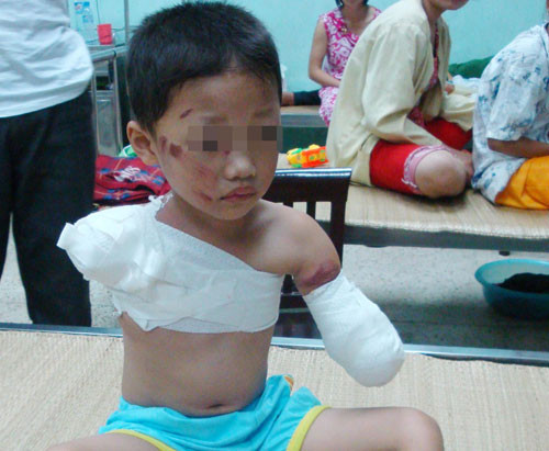 Cháu Q. sau phẫu thuật - Ảnh: Bệnh viện Nhi T.Ư cung cấp