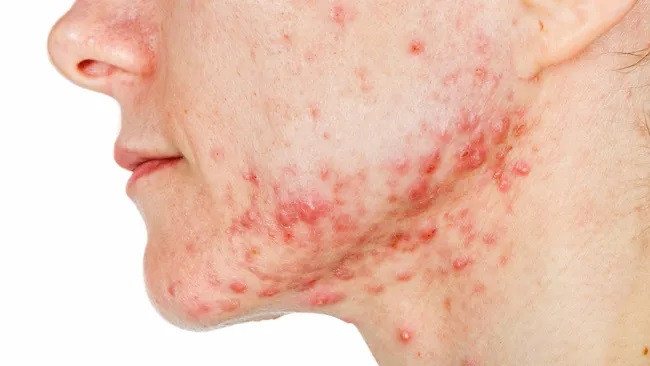 Trong một thử nghiệm lâm sàng, các nhà khoa học đang nghiên cứu xem liệu vắc xin có thể điều trị cho những bệnh nhân bị mụn trứng cá ở mặt từ trung bình đến nặng hay không. (Ảnh: Obencem) Trong một thử nghiệm lâm sàng, các nhà khoa học đang nghiên cứu xem liệu vắc xin có thể điều trị cho những bệnh nhân bị mụn trứng cá ở mặt từ trung bình đến nặng hay không. (Ảnh: Obencem)