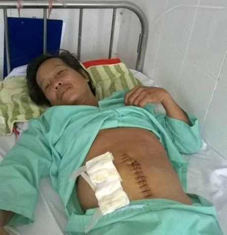 Phẫu thuật lấy cây tăm tre trong ruột bệnh nhân ảnh 1