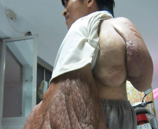 Bệnh nhân Lê Thanh Vũ 