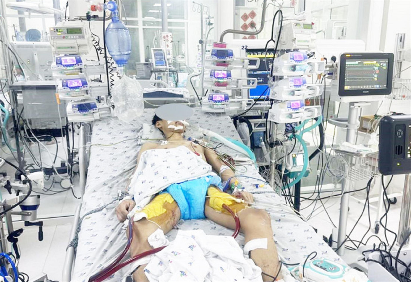 Một trường hợp trẻ bị viêm cơ tim cấp được can thiệp ECMO tại Bệnh viện Nhi đồng TPHCM. Ảnh: BSCC