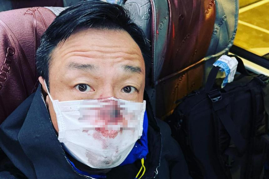 Vương Hỷ gây sốc với hình ảnh khẩu trang đẫm máu sau khi xét nghiệm COVID-19.